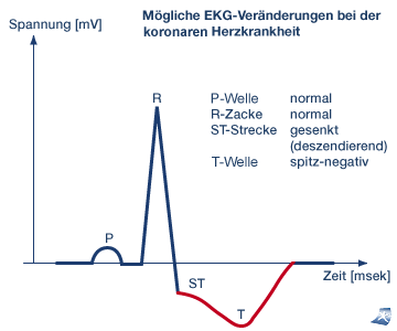 Das Bild zeigt eine EKG-Ver�nderung.
