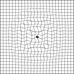 Man sieht ein m�gliches Ergebnis des Amsler-Gitter-Tests.