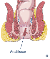 Schematische Darstellung einer Analfissur
