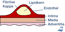 Das Bild zeigt den schematischen Aufbau einer fortgeschrittenen arteriosklerotischen Plaques