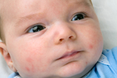 Babyakne