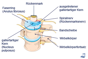 Darstellung eines Bandscheibenvorfalls