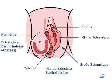 Das Bild zeigt einen Abszess an der Bartholini�schen Dr�se
