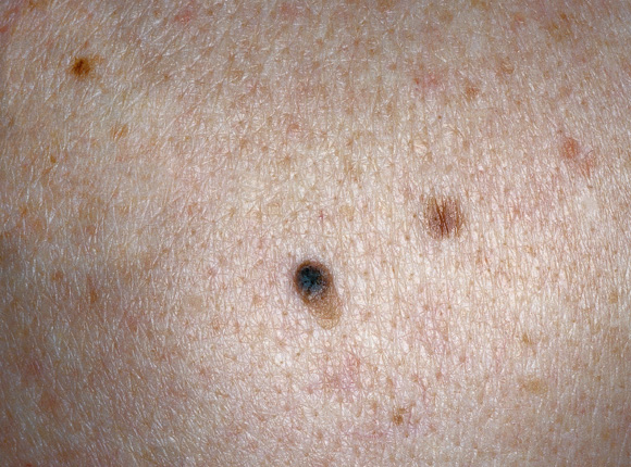 Die Pigmentation auf der Person herauszuführen,