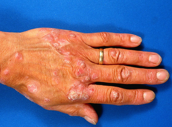 Samara el tratamiento de la psoriasis el sanatorio