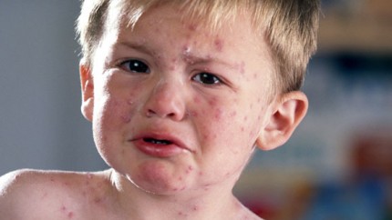 Visual guide to children's rashes and skin conditions ...