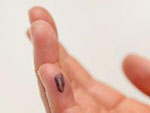 Eine Blase an einer Hand.
