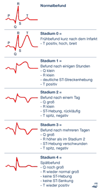 EKG-Verlauf beim Infarkt EKG