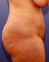 Bauch nach einer Fettsch�rzenentfernung