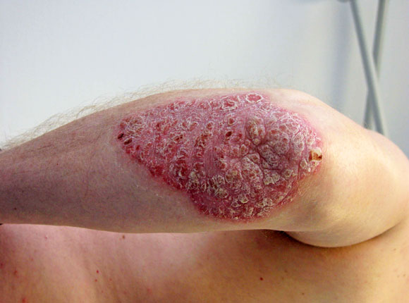 Rozamet et le psoriasis
