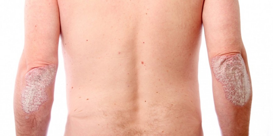 Le psoriasis de la partie chevelue de la photo