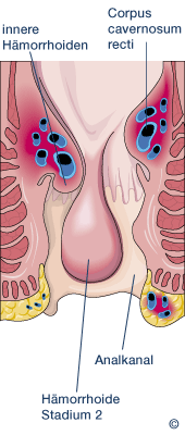 Schematische Darstellung von H�morrhoiden