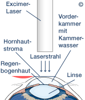 Darstellung des Lasik-Vorgangs