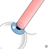 Laserstrahl auf Auge