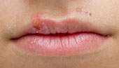 Das Bild zeigt Herpes an der Oberlippe.