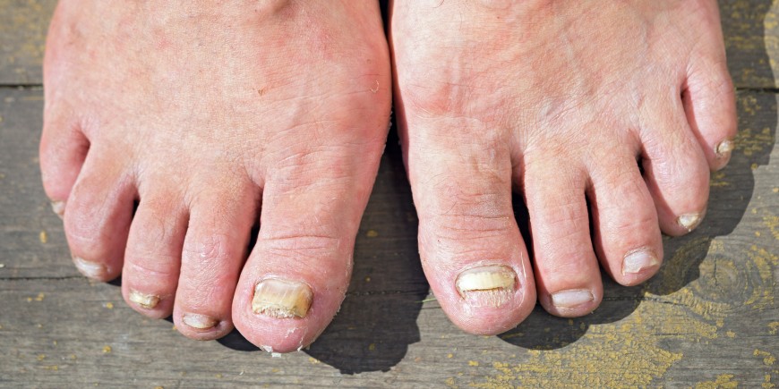 Propolis und gribok die Füsse