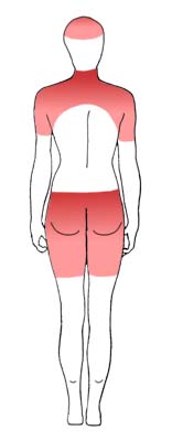 polymyalgia