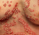 La varicela a los niños con atopicheskim por la dermatitis