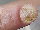 Das Bild zeigt einen psoriatischen Fingernagel.