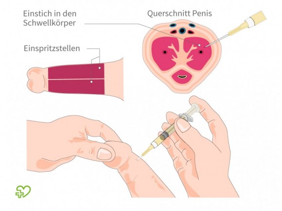 Welches es Mittel gegen die Potenz für die Männer ist