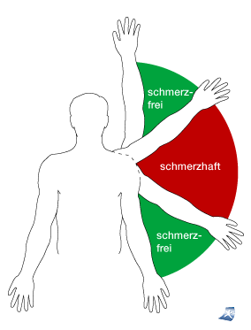 Darstellung des schmerzhaften Bogens beim seitlichen Anheben des Arms