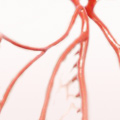 Arteriosklerose
