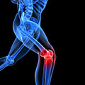 Arthrose-Risikotest