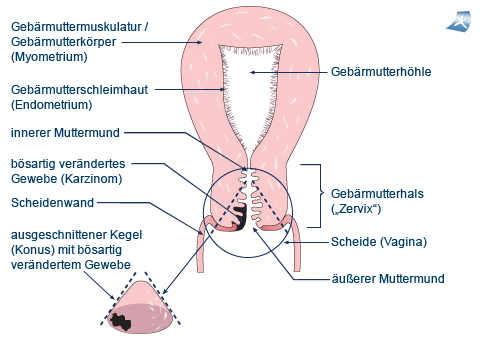 Konisation (Therapieverfahren) bei Geb�rmutterhalskrebs