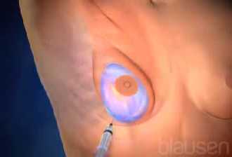 Neue Form dank Implantaten