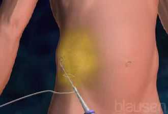 L�stiges Bauchfett loswerden