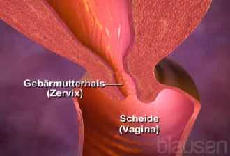 Ver�nderte Zellen im Geb�rmutterhals