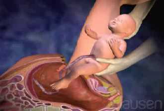 Ces�rea: un parto a trav�s de la pared abdominal