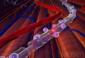Lesiones nerviosas debidas a la diabetes