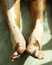 Fu� mit Vitiligo