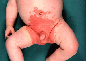 Das Bild zeigt eine Windeldermatitis.