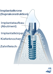 Aufbau eines Zahnimplantats
