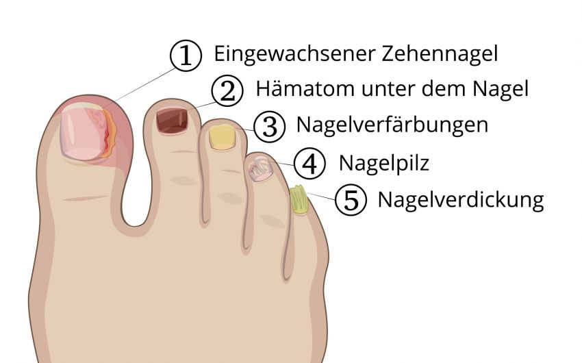 Jede Erkrankung der Zehennägel benötigt eine eigene Form der Behandlung – vom Fußpilz bis zu eingewachsenen Zehennägeln.