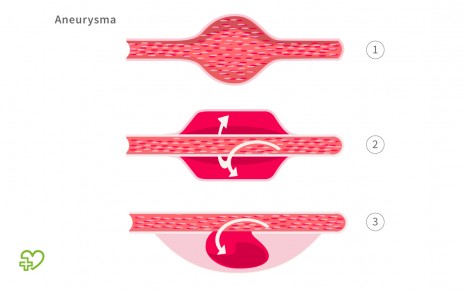 Aneurysma-Formen: Aneurysma verum (1), Aneurysma dissecans (2) und Aneurysma spurium (3)