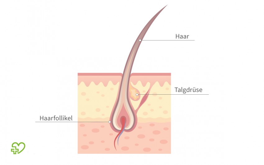 Haarfollikel sind die kleinen Hautausstülpungen, in denen jedes einzelne Haar verankert ist. Beim erblichen bedingten Haarausfall schrumpfen sie mit der Zeit.
