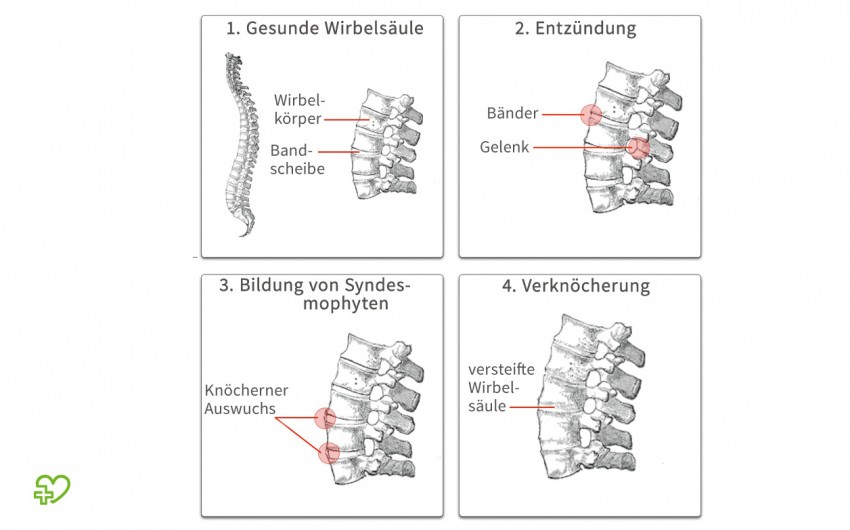 Die Grafik zeigt den zeitlichen Verlauf des Morbus Bechterew.