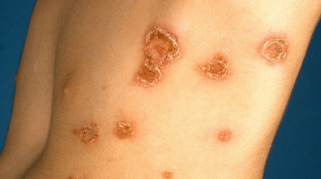 Uberblick Uber Die Impetigo Contagiosa Ansteckende Borkenflechte Onmeda De