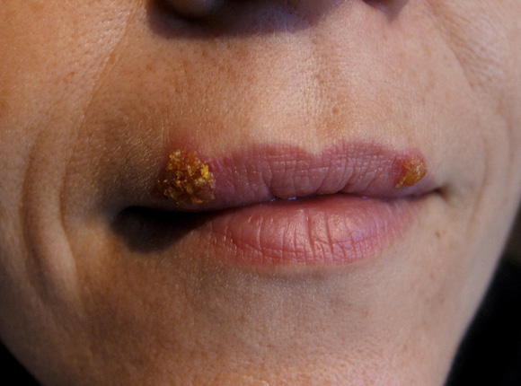 Lippenherpes Herpes Labialis Vorbeugen Behandeln Onmeda De