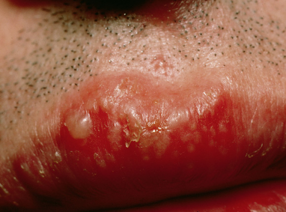 herpes an der lippe anfang