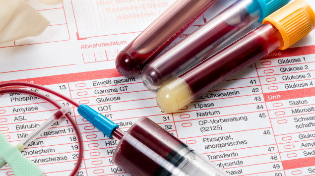 Bilirubin ist im Blut nachweisbar. Bei bestimmten Erkrankungen steigt auch der Bilirubin-Wert im Urin.