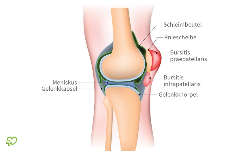 Schleimbeutel dienen als eine Art Dämpfer zwischen Knochen und weichem Gewebe. Im Knie gibt es gleich mehrere Schleimbeutel, die sich durch ständige Belastungen entzünden können. Häufiges Hinknien (z.B. beim Fliesenlegen) erhöht das Risiko für eine Bursitis. Helfen können kühlende Umschläge sowie schmerz- und entzündungshemmende Medikamente.