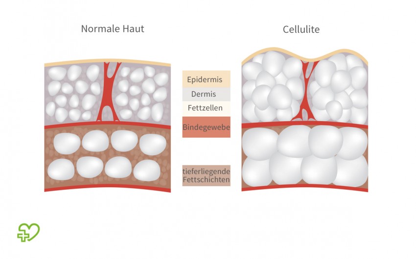 Man sieht Cellulite und normale Haut im Vergleich.
