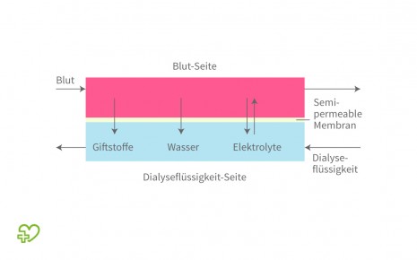 Darstellung der Dialyse.
