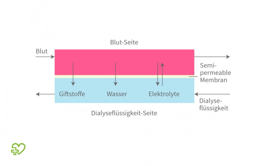 Darstellung der Dialyse.