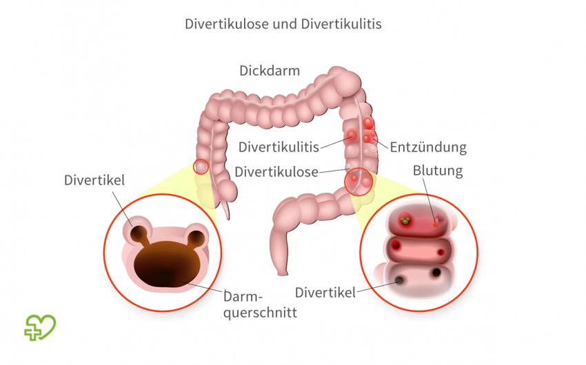 Grafische Darstellung von Divertikulose und Divertikulose