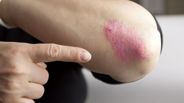 Ein Ellenbogen mit Schuppenflechte: Psoriasis lässt sich bislang nicht heilen, aber gut behandeln.